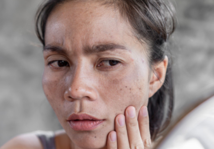 Lão hóa khuôn mặt: Hiểu đúng để lựa chọn đúng - BS Phạm Hồ Nam