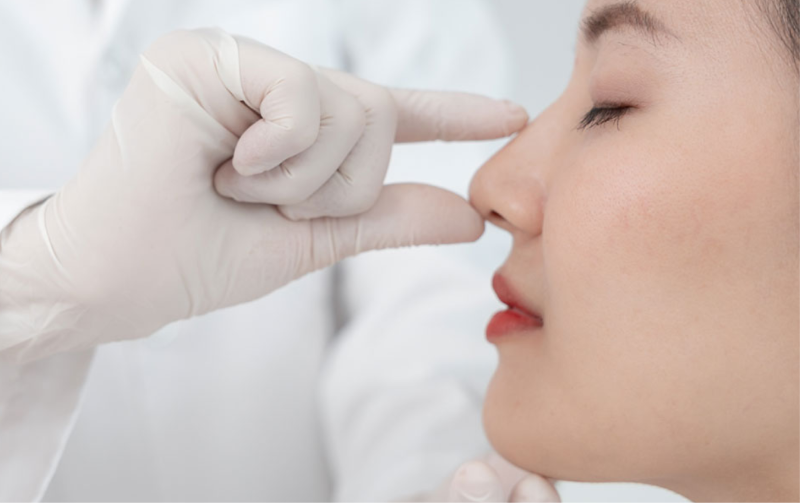 Nâng mũi cấu trúc: Khi nào thực sự cần và ai không nên làm?