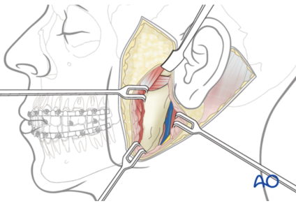 Quy trình một ca phẫu thuật căng da mặt như thế nào?
