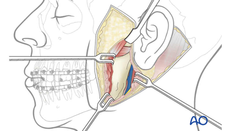 Quy trình một ca phẫu thuật căng da mặt như thế nào?