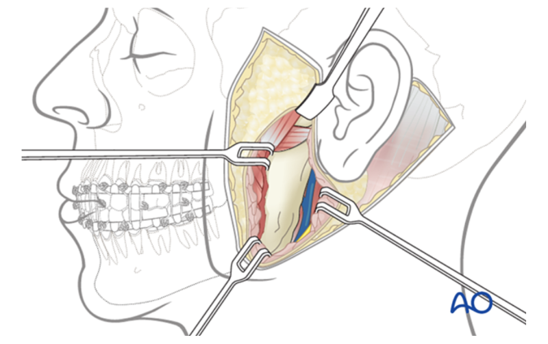 Quy trình một ca phẫu thuật căng da mặt như thế nào?