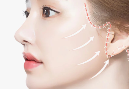 Phẫu thuật căng da mặt: Phương pháp trẻ hóa da toàn diện và lâu dài