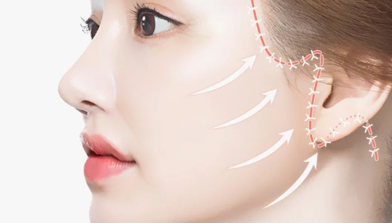 Phẫu thuật căng da mặt: Phương pháp trẻ hóa da toàn diện và lâu dài