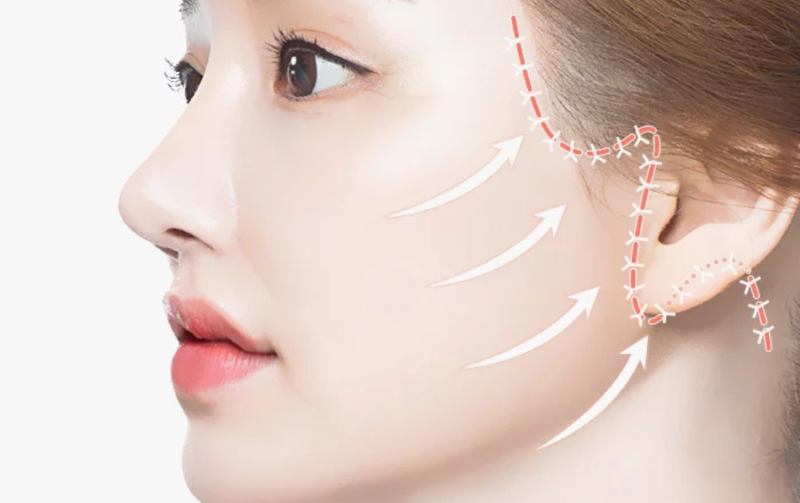 Phẫu thuật căng da mặt: Phương pháp trẻ hóa da toàn diện và lâu dài