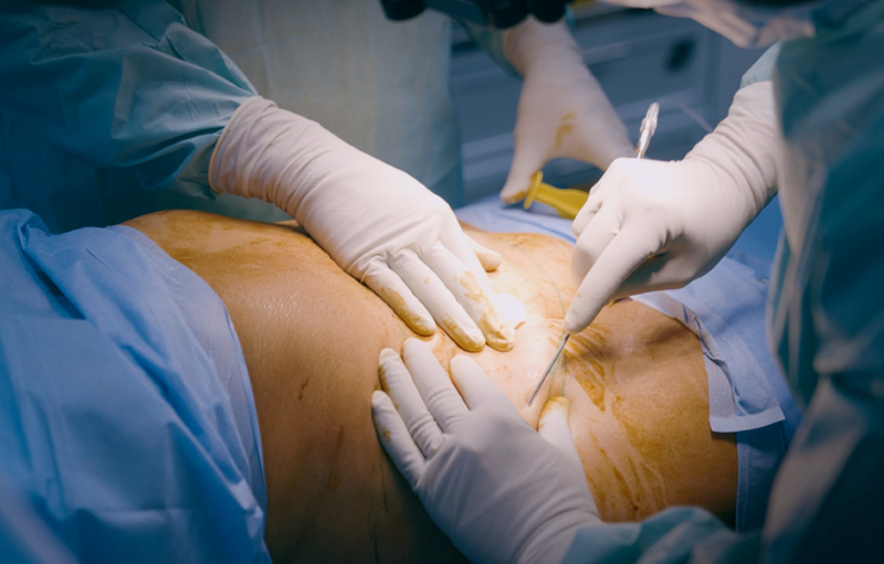 Bác sĩ Phạm Hồ Nam thực hiện hút mỡ