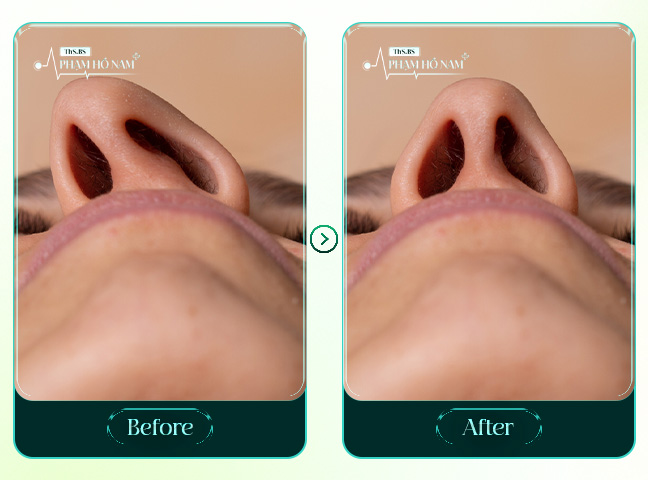 ca chỉnh mũi hỏng BS Phạm Hồ Nam thực hiện