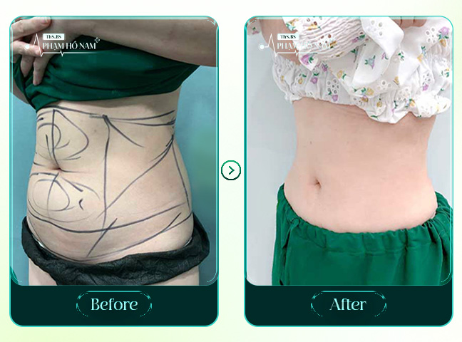 Case hút mỡ tạo hình vùng bụng BS Hồ Nam
