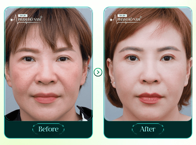 Case phẫu thuật căng da bán phần - BS Phạm Hồ Nam