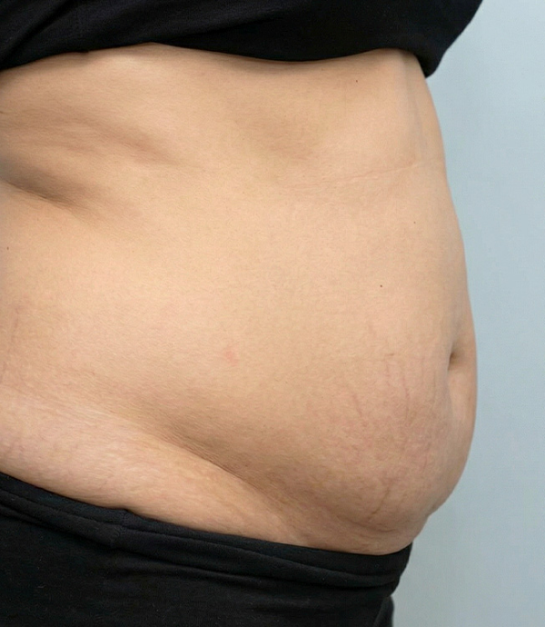 Hút mỡ bụng dưới to với BS Phạm Hồ Nam