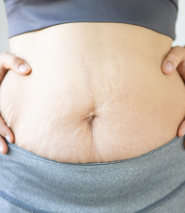 Hút mỡ bụng sau sinh - BS Phạm Hồ Nam