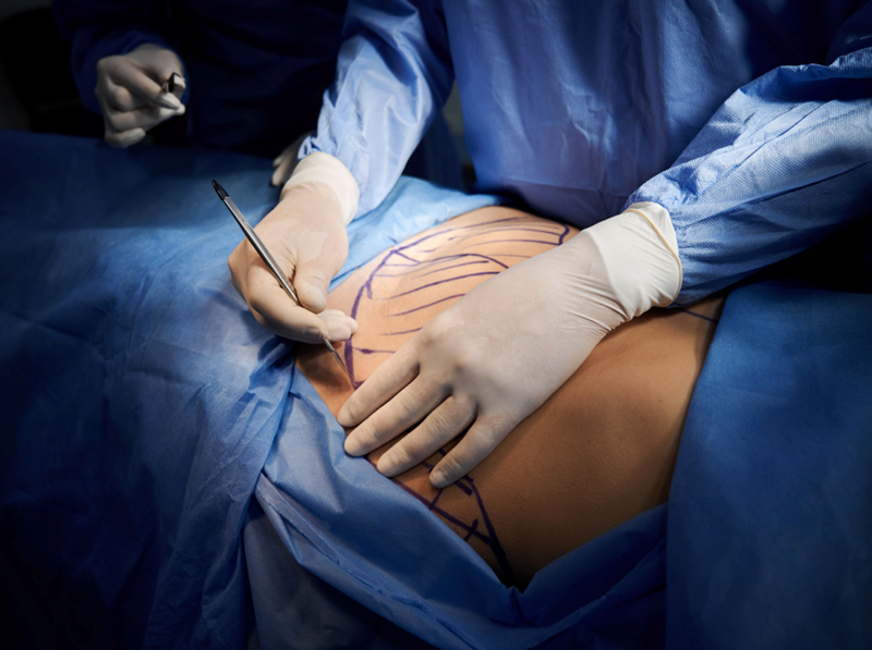 Hút mỡ eo thon gọn tại TP.HCM – Phạm Hồ Nam