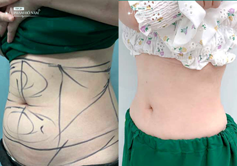 Kết quả hút mỡ tự nhiên – Phạm Hồ Nam