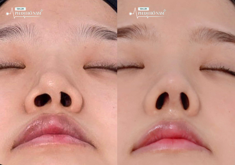Kết quả nâng mũi tự nhiên sau thực hiện – Phạm Hồ Nam