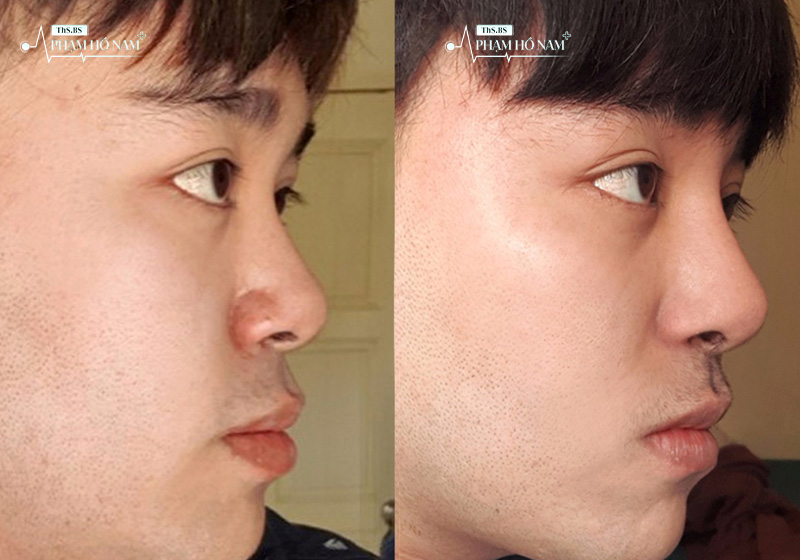 Kết quả thẩm mỹ nam tự nhiên – Thạc sĩ, Bác sĩ Phạm Hồ Nam