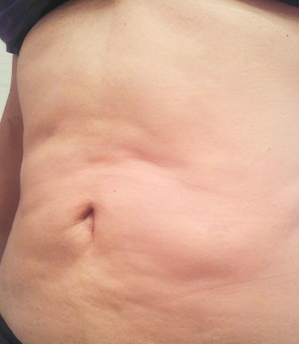 Khắc phục mỡ bụng lồi lõm - BS Phạm Hồ Nam