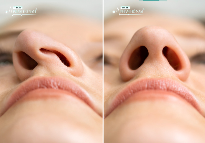 Khách hàng cải thiện sau chỉnh sửa thẩm mỹ – Phạm Hồ Nam