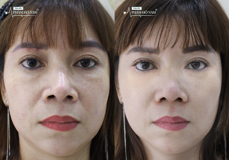 Khách hàng sau khi cắt mí tại TP.HCM – Thạc sĩ, Bác sĩ Phạm Hồ Nam