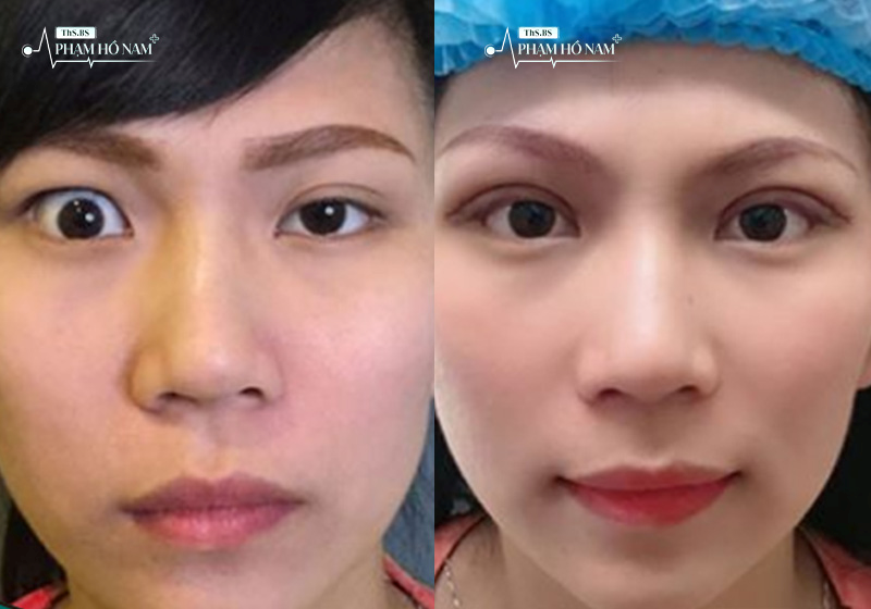 Khách hàng chỉnh sửa thẩm mỹ thành công tại TP.HCM – Thạc sĩ, Bác sĩ Phạm Hồ Nam