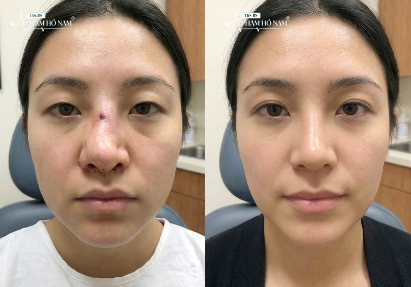 Khách hàng thực hiện chỉnh sửa thẩm mỹ tại TP.HCM – Phạm Hồ Nam