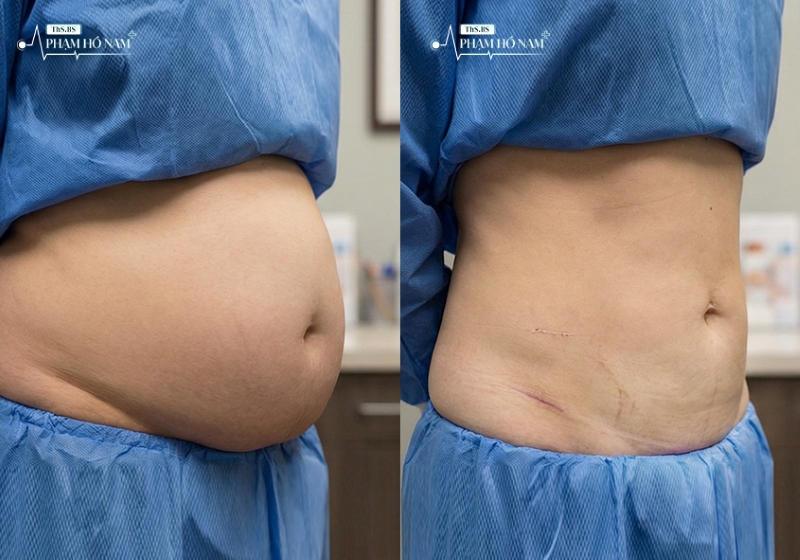 Khách hàng hài lòng với kết quả hút mỡ – Phạm Hồ Nam