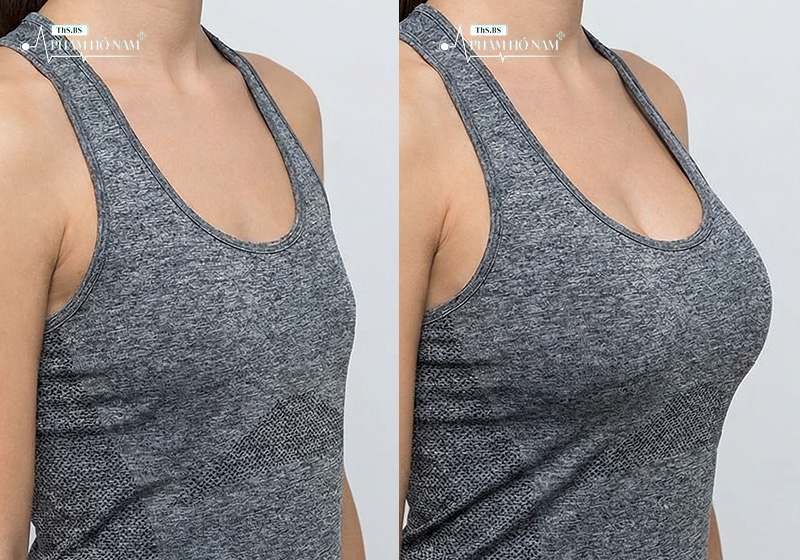 Khách hàng hài lòng sau nâng ngực – Thạc sĩ, Bác sĩ Phạm Hồ Nam