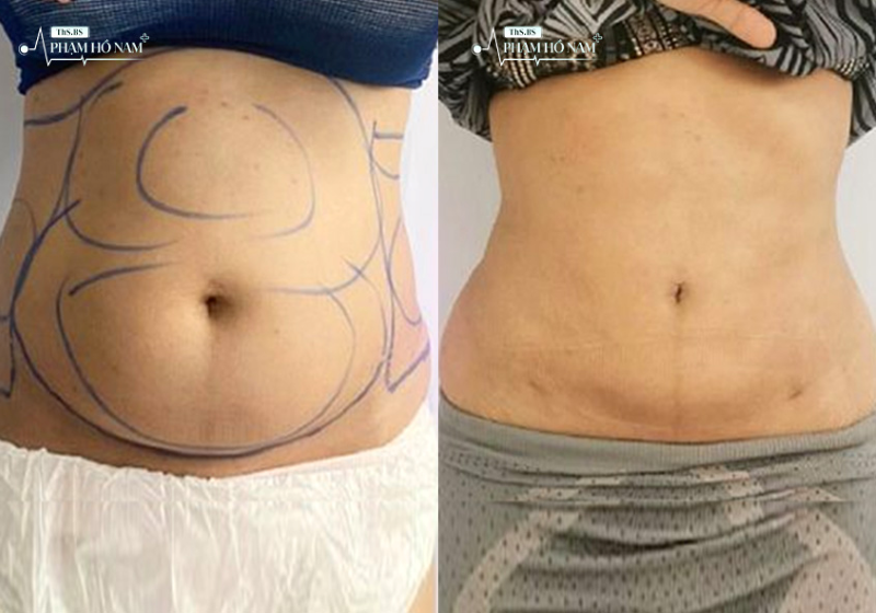 Khách hàng hài lòng sau hút mỡ – Thạc sĩ, Bác sĩ Phạm Hồ Nam