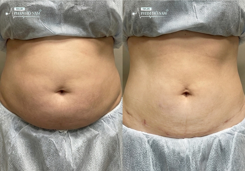 Khách hàng thực hiện hút mỡ tại TP.HCM – Thạc sĩ, Bác sĩ Phạm Hồ Nam