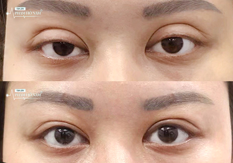 Khách hàng khắc phục thẩm mỹ – Thạc sĩ, Bác sĩ Phạm Hồ Nam