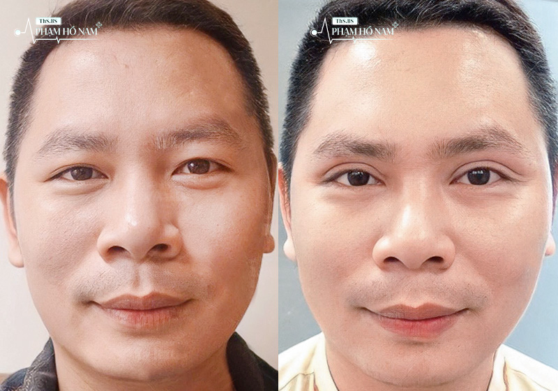 Khách hàng nam hài lòng sau thẩm mỹ tại TP.HCM – Thạc sĩ, Bác sĩ Phạm Hồ Nam