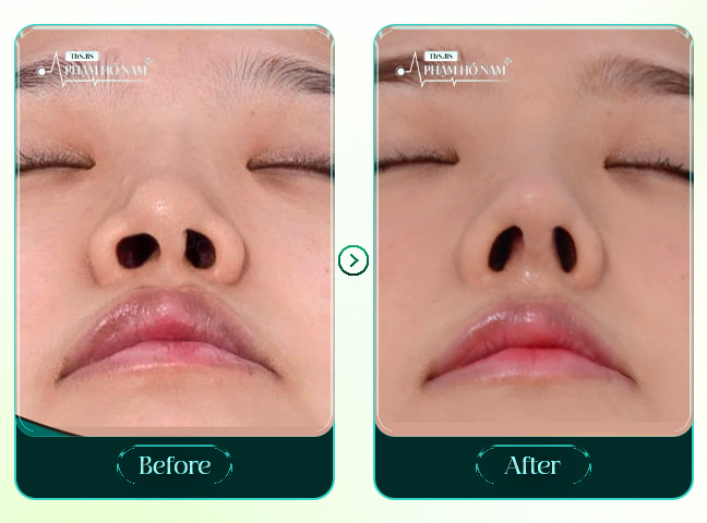 Khách hàng nâng mũi cấu trúc bác sĩ Phạm Hồ Nam