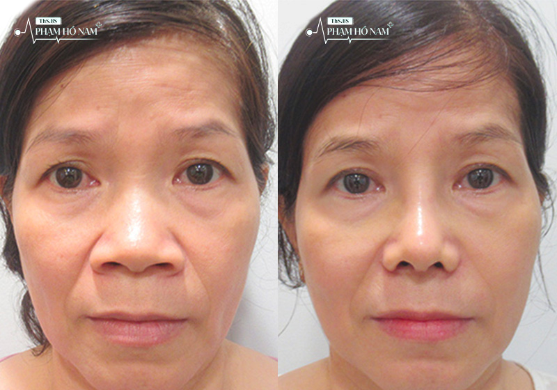 Khách hàng nâng mũi thực tế tại TP.HCM – Thạc sĩ, Bác sĩ Phạm Hồ Nam