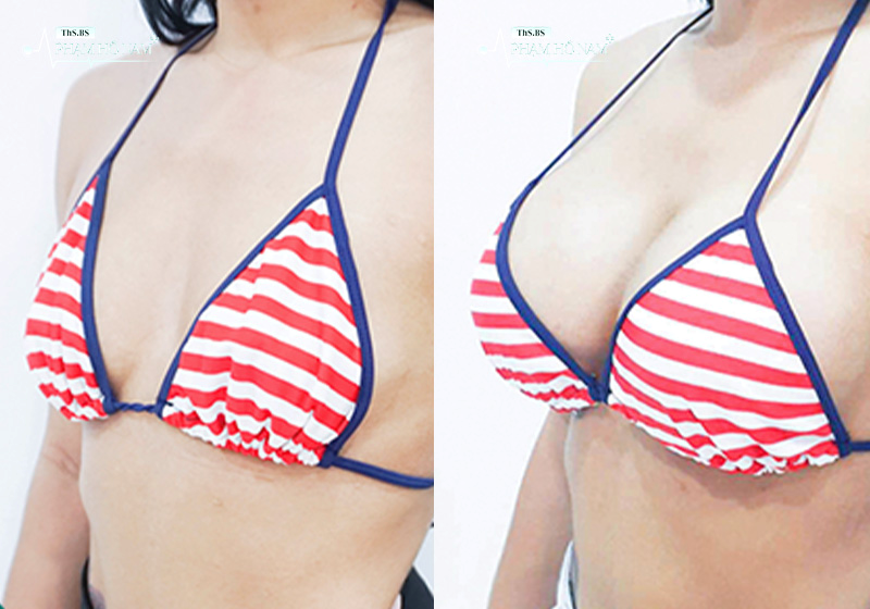 Khách hàng nâng ngực đẹp tự nhiên tại TP.HCM – Thạc sĩ, Bác sĩ Phạm Hồ Nam