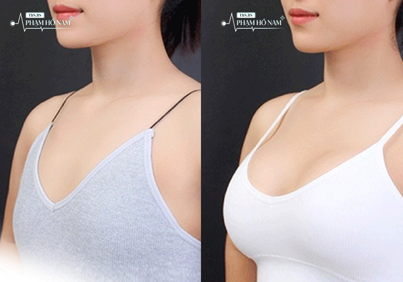 Khách hàng sử dụng dịch vụ nâng ngực tại TP.HCM – Phạm Hồ Nam