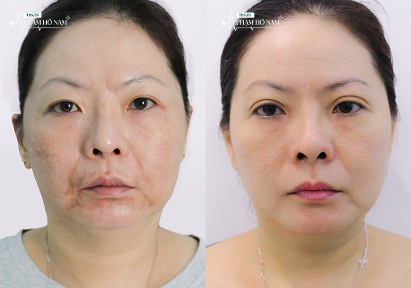 Khách hàng nhấn mí tại TP.HCM – Phạm Hồ Nam