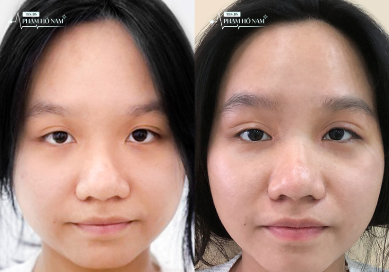 Khách hàng nữ sau thẩm mỹ mắt – Phạm Hồ Nam