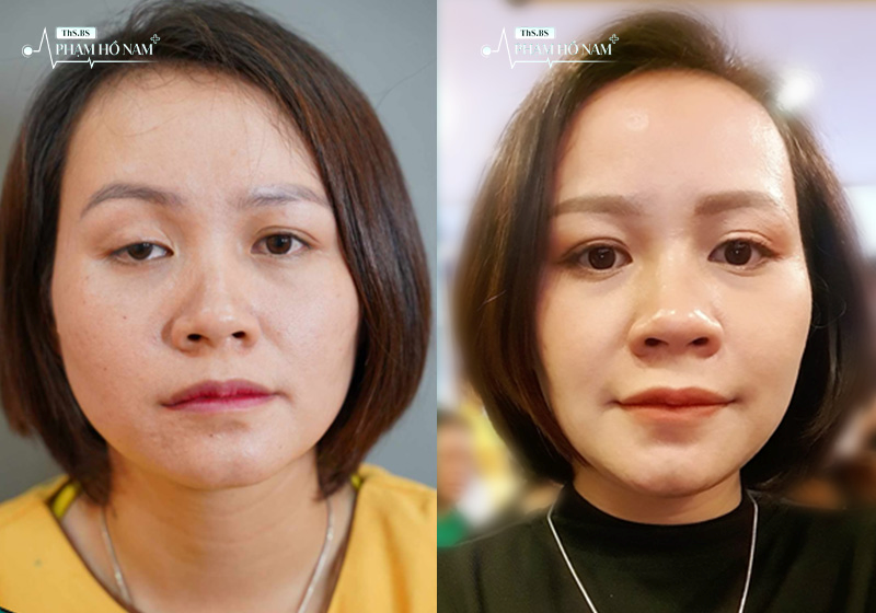 Khách hàng phục hồi sau thẩm mỹ – Thạc sĩ, Bác sĩ Phạm Hồ Nam