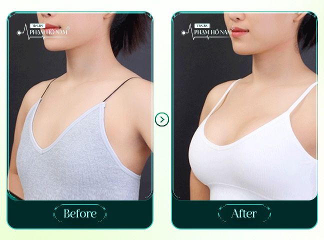 Khách hàng review nâng ngực bác sĩ Phạm Hồ Nam