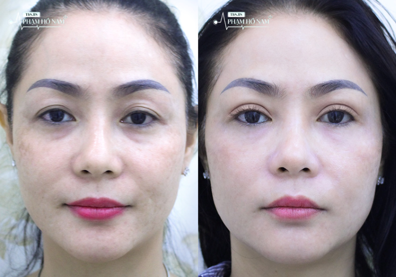 Khách hàng sử dụng dịch vụ thẩm mỹ mắt tại TP.HCM – Phạm Hồ Nam