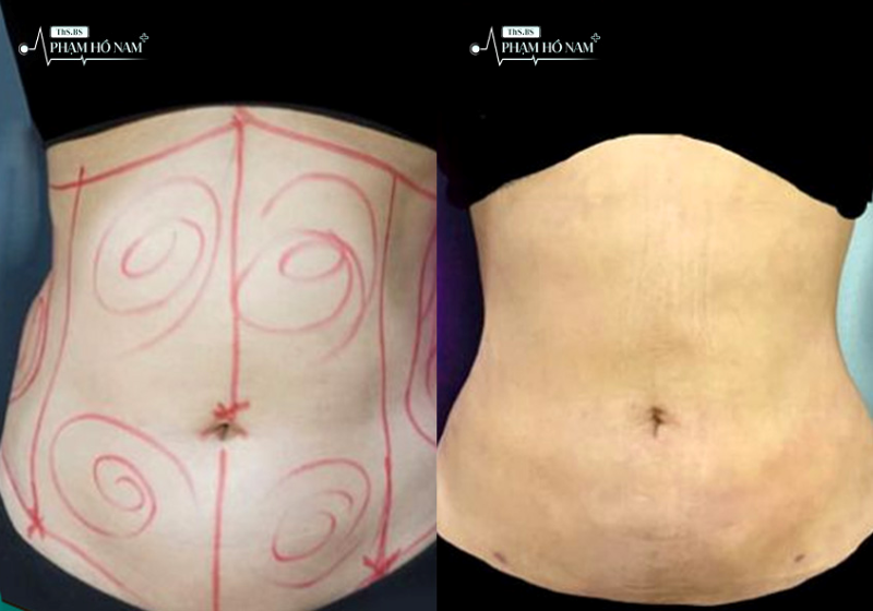 Khách hàng trải nghiệm hút mỡ tại TP.HCM – Phạm Hồ Nam