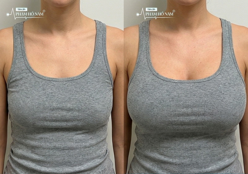 Khách hàng tự tin sau nâng ngực – Thạc sĩ, Bác sĩ Phạm Hồ Nam