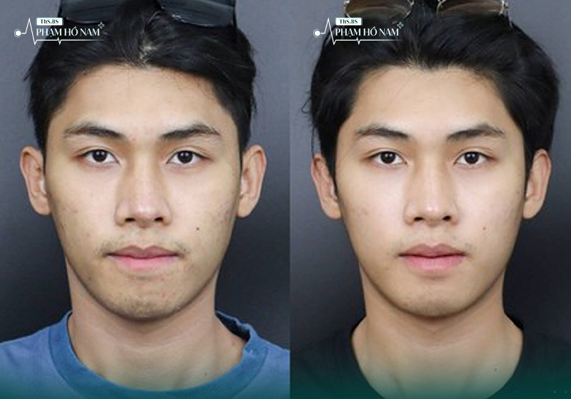Nam giới tự tin hơn sau khi thẩm mỹ – Phạm Hồ Nam