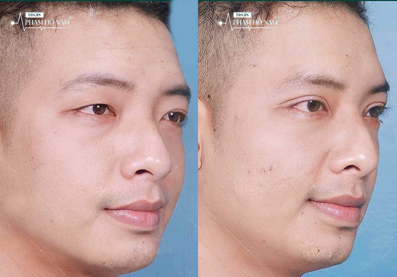 Nam giới tự tin hơn sau khi thẩm mỹ – Phạm Hồ Nam