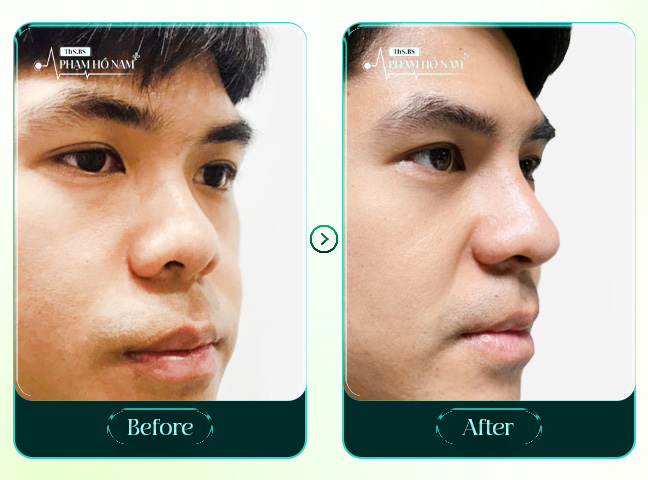 Nâng mũi cho nam BS Phạm Hồ Nam thực hiện