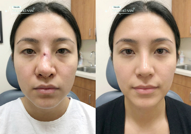 Kết quả nâng mũi trước sau đẹp tự nhiên – Phạm Hồ Nam