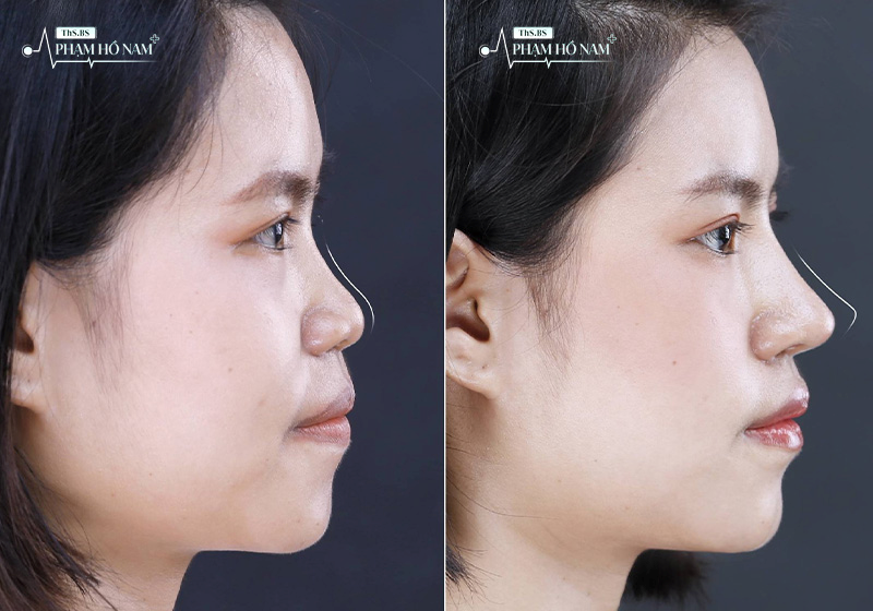 Hình ảnh trước và sau nâng mũi tại TP.HCM – Thạc sĩ, Bác sĩ Phạm Hồ Nam