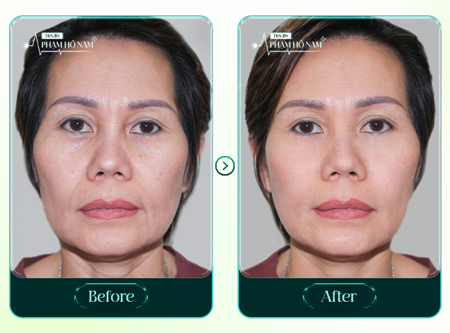 Phẫu thuật căng da mặt thực hiện bởi BS Phạm Hồ Nam