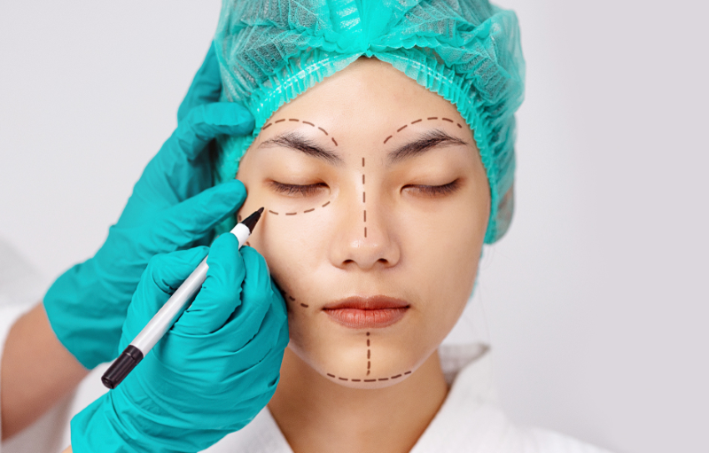 Quy trình phẫu thuật căng da mặt an toàn chuẩn y khoa