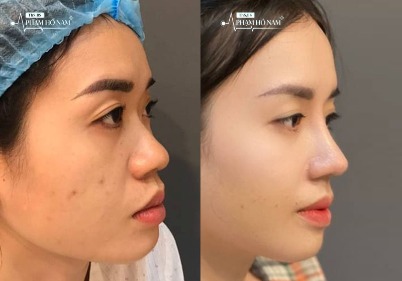 Sự thay đổi gương mặt sau nâng mũi – Thạc sĩ, Bác sĩ Phạm Hồ Nam