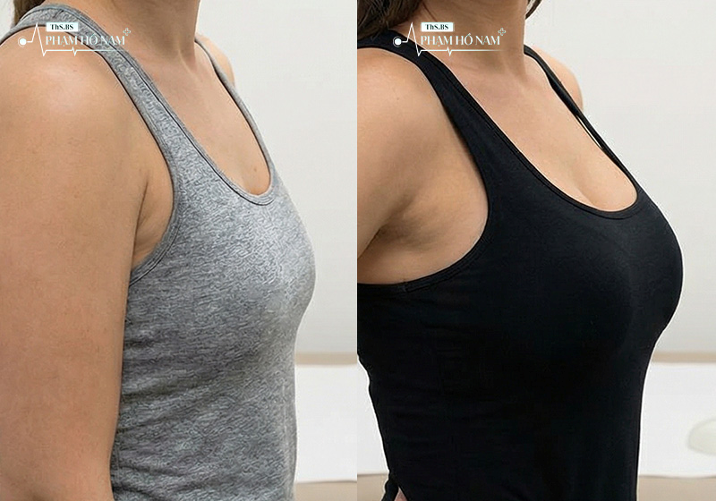 Trải nghiệm nâng ngực tại TP.HCM – Phạm Hồ Nam