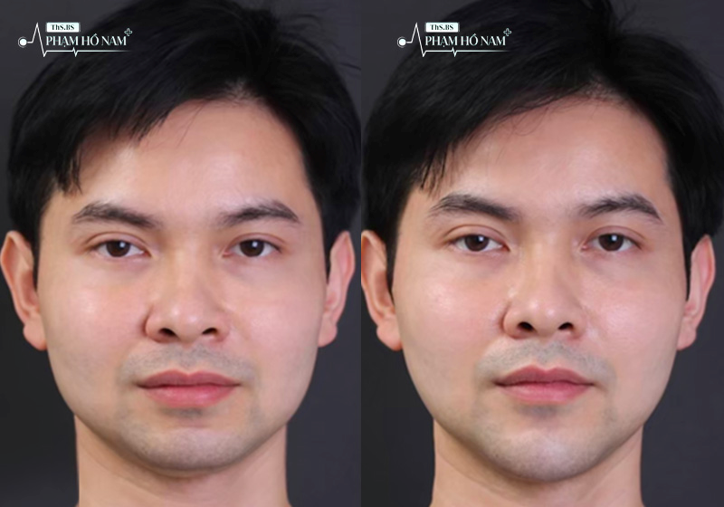 Trải nghiệm thẩm mỹ nam tại TP.HCM – Thạc sĩ, Bác sĩ Phạm Hồ Nam